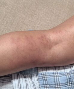 Dr. Nordyke's Wound Honey New Zealand Manuka Honey for Infections,Burns,Cuts and Scars (80g) 2.8 Ounce (Pack of 1) 26 71v3U0KozIL