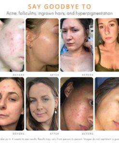 Face & Body Clearing Serum, Level 1- for acne, folliculitis, aging skin, ingrown hairs, dark spots - face, chest, butt, back, thighs, arms - mandelic acid - 1 fl oz 1 Fl Oz (Pack of 1) 18 71xGvRN5hL