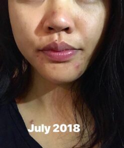 TruSkin Tea Tree Clear Skin Super Serum, Formulated with Tea Tree Oil, Vitamin C, Salicylic Acid, Niacinamide & Retinol, 1fl oz 1 Fl Oz (Pack of 1) 49 814UFJNcT6L 6