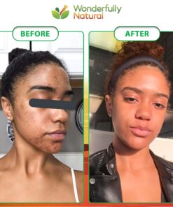 Organic African Black Soap - For Acne & Dark Spots | Natural Vegan and Cruelty Free – Satisfaction Guarantee 1lb bar | 90 day Supply 1 Pound (Pack of 1) 31 81BY1epApEL 1