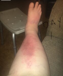 TEA TREE OIL BALM -100% All Natural | Great Cream for Soothing Irritations like Eczema, Psoriasis, Rashes, Insect Bites, Folliculitis, Acne, Itches, Dry Chapped Heels, Cuticles, Saddle Sores and more! 39 81Ddsgu7mwL