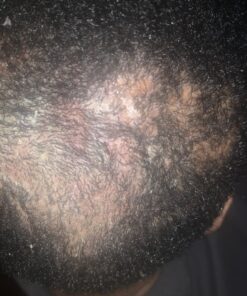 Organic Aloe Vera Gel - 100% Pure for Skin, Sunburn Relief & Face Moisturizer - Extracted from Aloe Vera Plant with Manuka Honey, Orchid & Apple Stem Cells - Everyday Use - 8 Fl Oz 8 Fl Oz (Pack of 1) 29 81EXnF xj5L