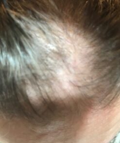 Hairgenics Pronexa Clinical Strength Hair Growth & Regrowth Therapy Hair Loss Shampoo With Biotin, Collagen, and DHT Blockers for Thinning Hair, 8 fl. oz. 36 81H6rNylh9L 2