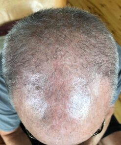 iRestore Essential Laser Hair Growth System - FDA Cleared Hair Loss Treatments for Men & Women & Hair Growth Products for Men with Thinning Hair, Hair Regrowth Treatments Laser Cap, Red Light Therapy 52 81JZ5uj4M L 1