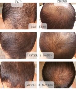 iRestore Essential Laser Hair Growth System - FDA Cleared Hair Loss Treatments for Men & Women & Hair Growth Products for Men with Thinning Hair, Hair Regrowth Treatments Laser Cap, Red Light Therapy 53 81Q2DqTuAdL 1