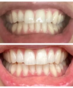 Auraglow 35% Teeth Whitening Gel Syringe Refill Pack, 35% Carbamide Peroxide, 30 Whitening Treatments, (3) 5mL Whitening Gel Syringes, Sensitive Teeth Whitening 40 81Q6AH EFHL