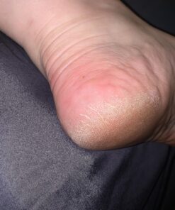 Kerasal Intensive Foot Repair, Skin Healing Ointment for Cracked Heels and Dry Feet, 1 Oz 40 81dL2KhrwPL