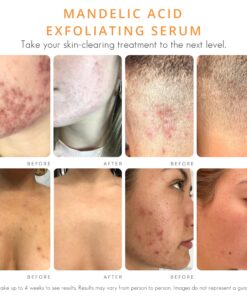 Face & Body Clearing Serum, Level 1- for acne, folliculitis, aging skin, ingrown hairs, dark spots - face, chest, butt, back, thighs, arms - mandelic acid - 1 fl oz 1 Fl Oz (Pack of 1) 16 81kDFsmZhpL