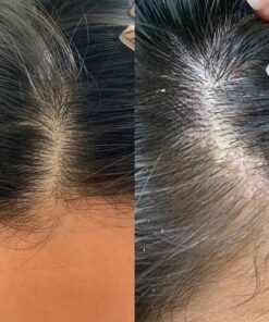 Selsun Blue 2-in-1 Anti-dandruff Shampoo & Conditioner, 11 fl. oz., Maximum Strength 2-in-1 Treatment, Selenium Sulfide 1% All Hair Colors 11 Fl Oz (Pack of 1) 18 81s9mi7lgSL