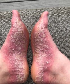 MG217 Psoriasis Treatment, Medicated Conditioning 2% Coal Tar Multi-Symptom Ointment, 3.8 Ounce Discontinued 3.8 Ounce 18 81xOX6xoVeL