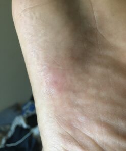 Compound W Maximum Strength Fast Acting Gel Wart Remover, 0.25 oz, 2 Pack unflavored 0.5 Ounce (Pack of 1) 42 81z7G Ndm7L