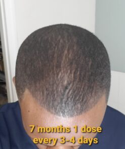 6 Months Kirkland Minoxidil 5% Extra Strength Hair Loss Regrowth Treatment Men, 12 Fl Oz (Pack of 6) 48 918igwN7pNL