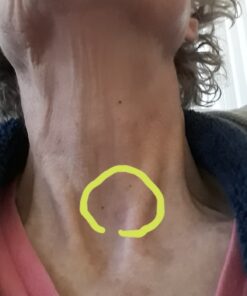 Compound W Nitrofreeze | Wart Removal | 1 Pen & 5 Replaceable Tips 65 91Oyi3jH GL