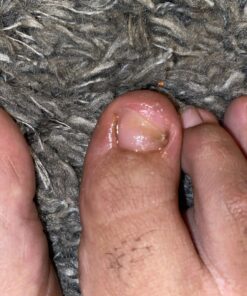 Toenail Fungus Treatment Extra Strength with 25% Undecylenic Acid - Fungal Nail Treatment for Toe Nail & Fingernails - Antifungal Nail Repair Solution for Discoloured & Ingrown Nails – Made in USA 0.5 Fl Oz (Pack of 1) 64 91jjtDSWq0L 1