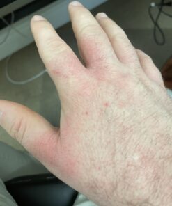 TEA TREE OIL BALM -100% All Natural | Great Cream for Soothing Irritations like Eczema, Psoriasis, Rashes, Insect Bites, Folliculitis, Acne, Itches, Dry Chapped Heels, Cuticles, Saddle Sores and more! 56 91ueNzu u2L