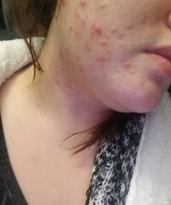 TruSkin Tea Tree Clear Skin Super Serum, Formulated with Tea Tree Oil, Vitamin C, Salicylic Acid, Niacinamide & Retinol, 1fl oz 1 Fl Oz (Pack of 1) 39 A1A9VYTFpLL