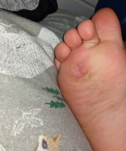 Compound W Nitrofreeze | Wart Removal | 1 Pen & 5 Replaceable Tips 64 A1D4FFE0VzL