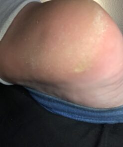 Kerasal Intensive Foot Repair, Skin Healing Ointment for Cracked Heels and Dry Feet, 1 Oz 42 A1OAbojK9AL