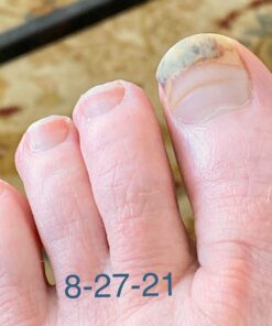 Extra Strength-100% All Natural Fungus Nail Solution for Toenail & Fingernails: Renew Thick, Broken & Discolored Nails Made by Purely Northwest -1fl.oz Tea Tree Oil 1 Fl Oz (Pack of 1) 36 A1q79drTjrL