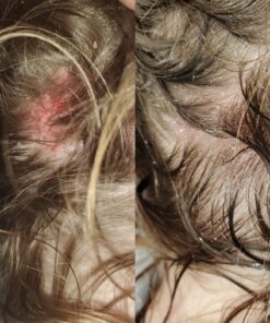 SkinSmart Antimicrobial Eczema Therapy with Hypochlorous Acid, Removes Bacteria so Skin Can Heal, for Adults, Kids and Seniors, 8 Ounce Clear Spray 8 Fl Oz (Pack of 1) 47 A1vCdVrGN9L