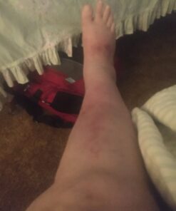 TEA TREE OIL BALM -100% All Natural | Great Cream for Soothing Irritations like Eczema, Psoriasis, Rashes, Insect Bites, Folliculitis, Acne, Itches, Dry Chapped Heels, Cuticles, Saddle Sores and more! 40 B1C3OWTSpGS