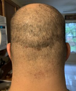 CLn® Shampoo - Clarifying Formula with Salicylic Acid, For Normal to Oily Scalp Prone to Folliculitis, Dandruff, Itchy & Flaky Scalp, Fragrance-Free & Paraben-Free, 8 fl. oz. 8 Fl Oz (Pack of 1) 25 B1MH9DHbXjS