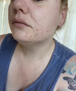 TruSkin Tea Tree Clear Skin Super Serum, Formulated with Tea Tree Oil, Vitamin C, Salicylic Acid, Niacinamide & Retinol, 1fl oz 1 Fl Oz (Pack of 1) 53 B1Y1WweHMS 1