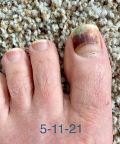 Extra Strength-100% All Natural Fungus Nail Solution for Toenail & Fingernails: Renew Thick, Broken & Discolored Nails Made by Purely Northwest -1fl.oz Tea Tree Oil 1 Fl Oz (Pack of 1) 37 B1zcG7mj6tS
